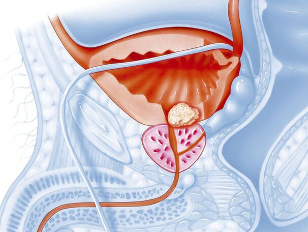 La forme bactérienne de la prostatite
